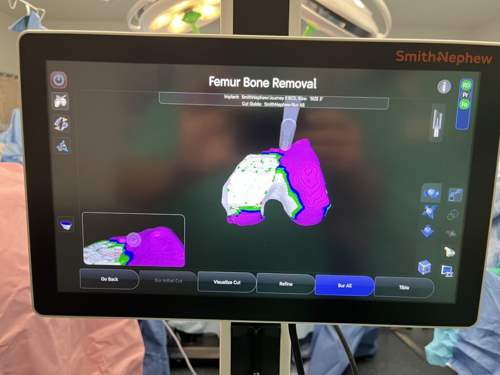 IMG_6330 - RobotMD Smith & Nephew CORI System